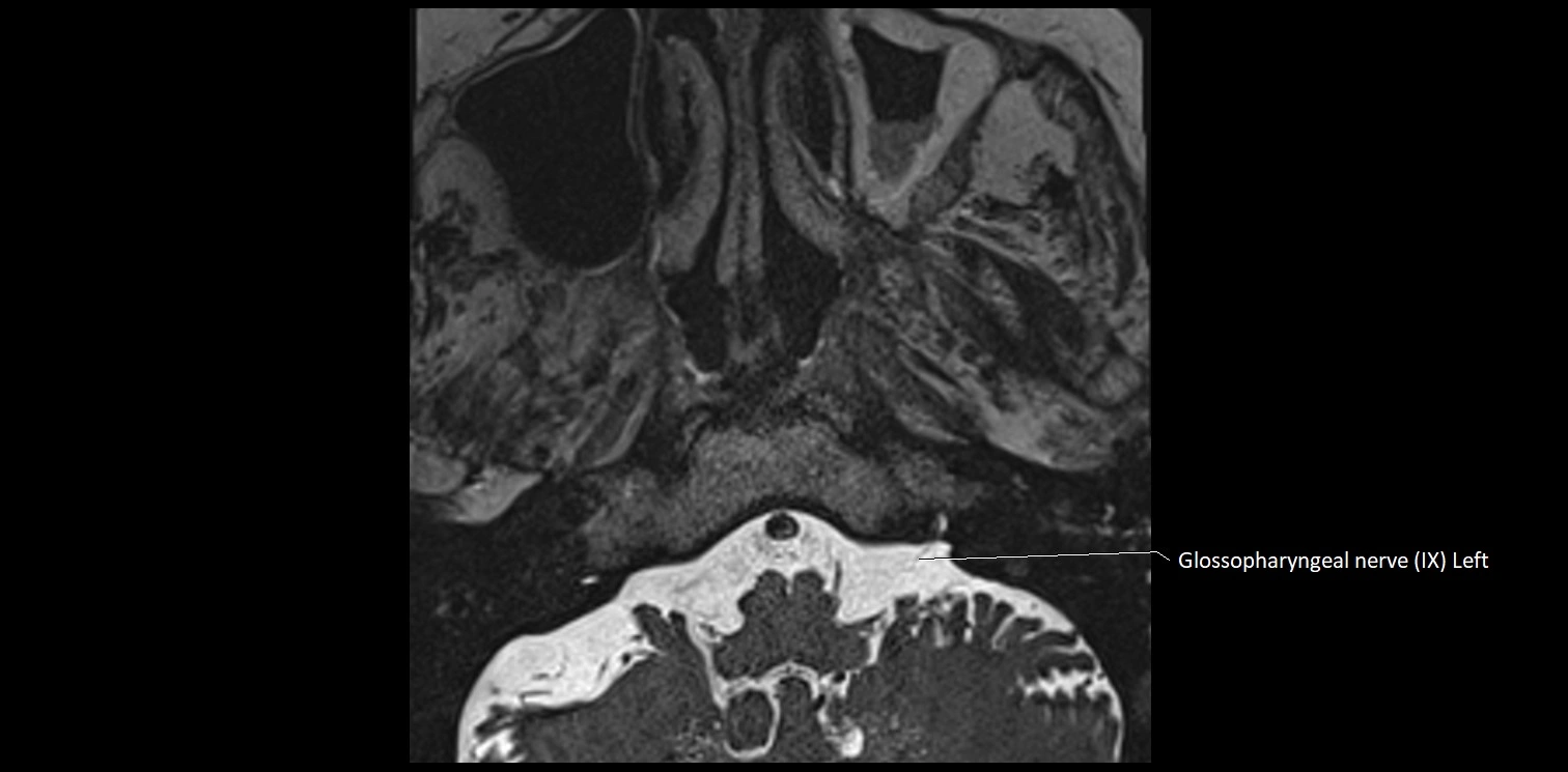 Cranial nerve anatomy axial MRI 3T image 66.webp